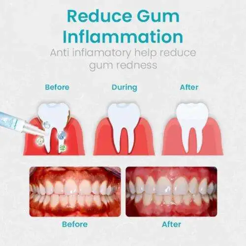 Tooth Repair Gel, Max 80% Off - Clean Deep, Firm Tartar, Soothe Gums!