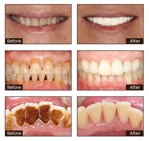 💥HUGE DISCOUNT - 50% OFF! LIMITED TIME! Niacinamide Whitening Toothpaste for a Bright Smile.💪 GRAB IT NOW!
