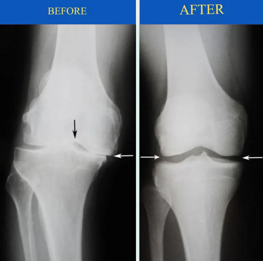Say goodbye to knee pain