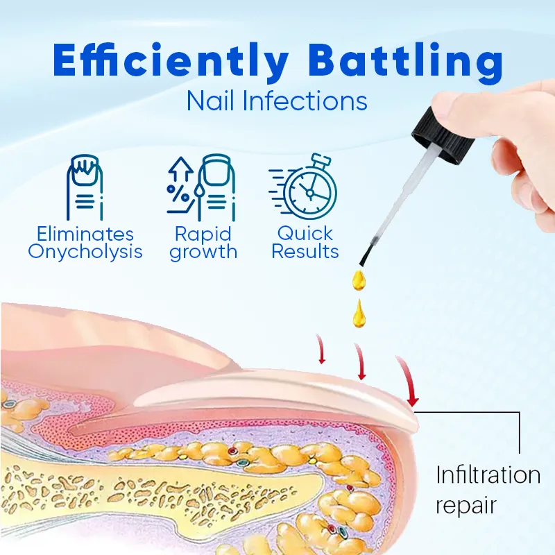 🚨FLASH SALE - 50% OFF!🔥URGENT! LIMITED TIME! OnyxoGuard Nail Growth and Repair Serum for Beautiful Nails.🛒ORDER NOW!