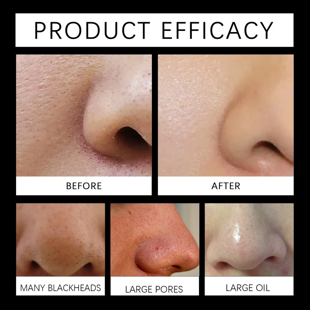 Men's Blackhead and Pore Treatment Patch
