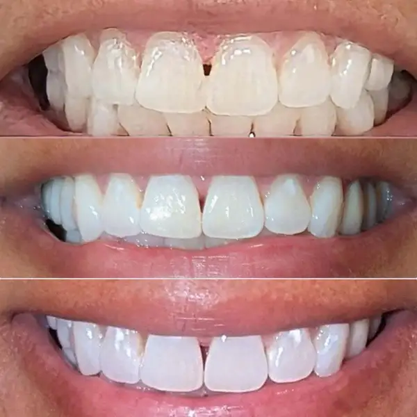 Teeth Whitening Serum, Color-Correcting Serum to Neutralize Yellow Stains