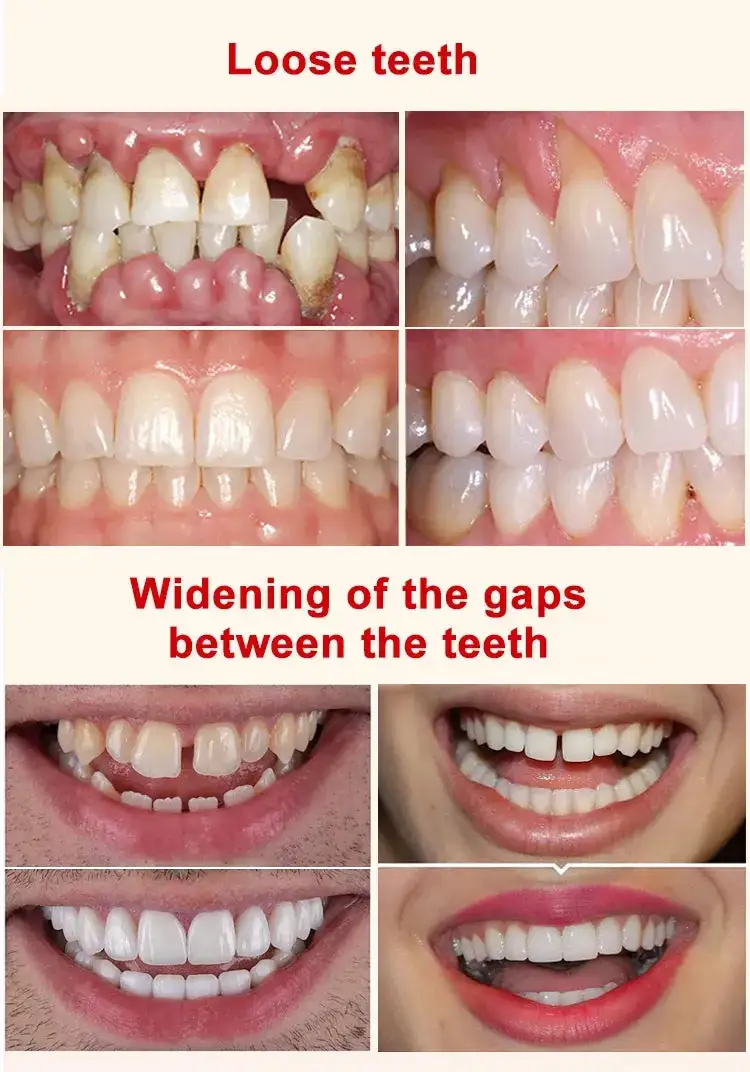 Tooth Repair Gel, Max 80% Off - Clean Deep, Firm Tartar, Soothe Gums!
